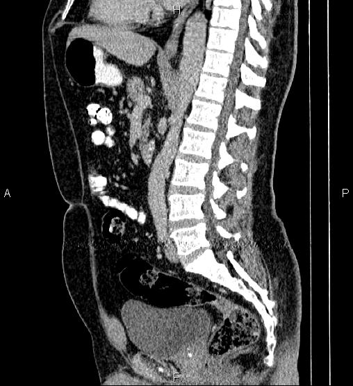 Acute appendicitis (Radiopaedia 84780-100240 Sagittal C+ portal venous phase 54).jpg