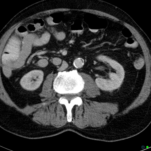 File:Acute appendicitis arising from a malrotated cecum (Radiopaedia 19970-19997 Axial C+ portal venous phase 15).jpg