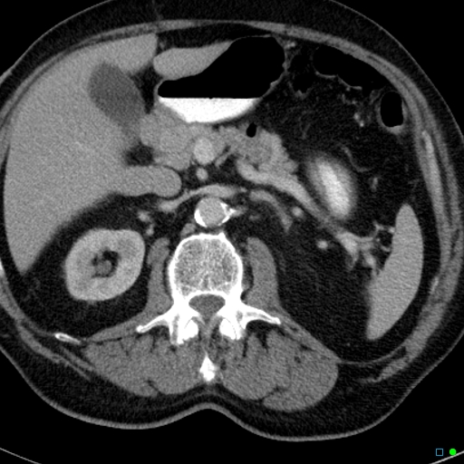 File:Acute appendicitis arising from a malrotated cecum (Radiopaedia 19970-19997 Axial C+ portal venous phase 5).jpg
