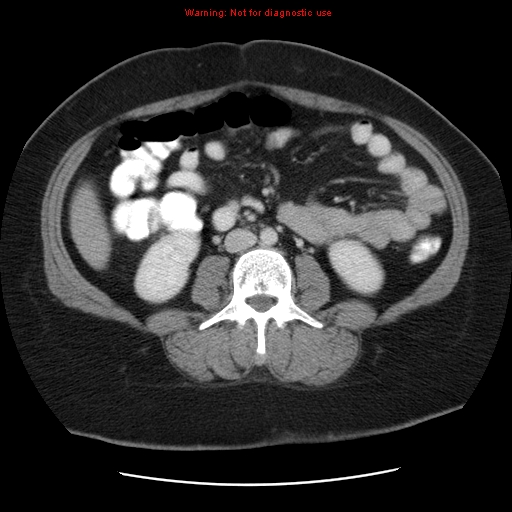 Acute appendicitis complicated by ovarian vein thrombophlebitis (Radiopaedia 16172-15851 Axial C+ portal venous phase 51).jpg