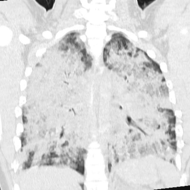 Acute aspiration pneumonitis (Radiopaedia 33605-34703 Coronal lung window 53).jpg
