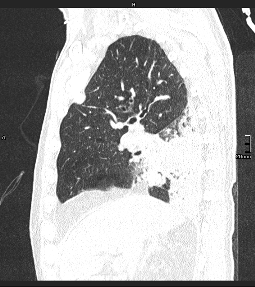 File:Acute aspiration pneumonitis (Radiopaedia 55642-62166 Sagittal lung window 101).jpg