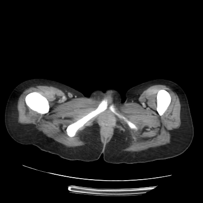Acute calculous cholecystitis in patient with osteopetrosis (Radiopaedia 77871-90159 Axial C+ portal venous phase 85).jpg