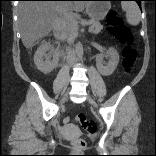 Acute cholecystitis and ureteric colic (Radiopaedia 42330-45444 Coronal prone 61).jpg