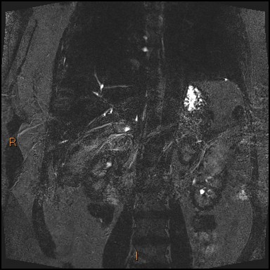 File:Acute cholecystitis with gallbladder neck calculus (Radiopaedia 42795-45971 Coronal Turbo spin echo 9).jpg
