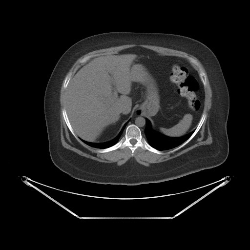 Acute cholecystitis with tensile fundus sign (Radiopaedia 71394-81723 Axial non-contrast 6).jpg
