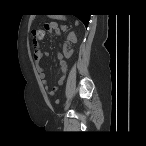 File:Acute cholecystitis with tensile fundus sign (Radiopaedia 71394-81723 Sagittal non-contrast 111).jpg
