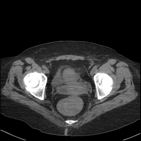Acute colonic hemorrhage in ulcerative colitis (Radiopaedia 77415-89538 Axial non-contrast 124).jpg