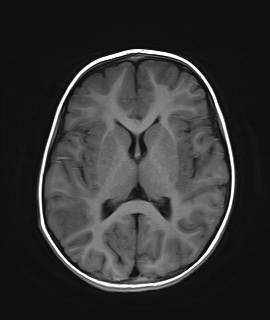 File:Acute disseminating encephalomyelitis with bilateral optic neuritis (Radiopaedia 79676-92886 Axial T1 14).jpg