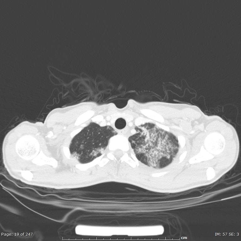 Acute eosinophilic pneumonia (Radiopaedia 48211-53073 Axial lung window 7).jpg