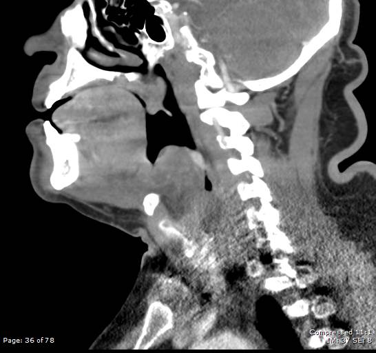 Acute epiglottitis (Radiopaedia 54375-60590 Sagittal C+ arterial phase 36).jpg