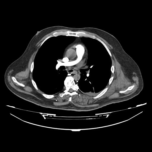 Acute heart failure (CT) (Radiopaedia 79835-93075 Axial C+ arterial phase 13).jpg
