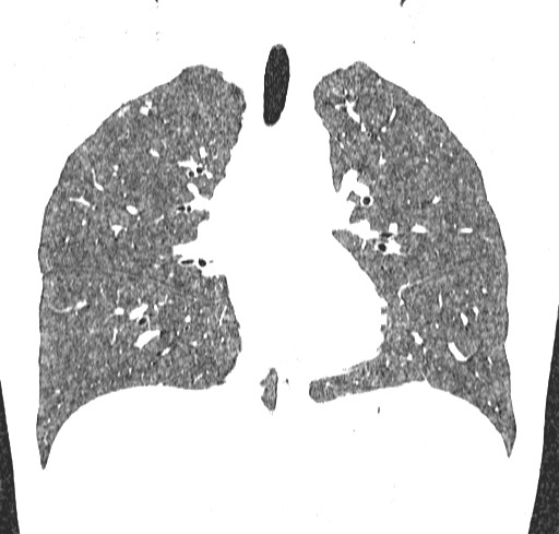 File:Acute hypersensitivity pneumonitis (Radiopaedia 85293-100870 Coronal lung window 61).jpg