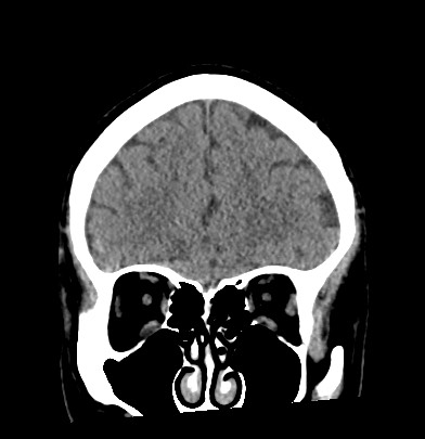 Acute internal carotid artery dissection (Radiopaedia 53541-59558 Coronal non-contrast 20).jpg