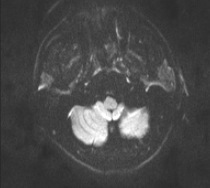 Acute ischemic stroke - posterior circulation territory (Radiopaedia 77670-89880 Axial DWI 26).jpg