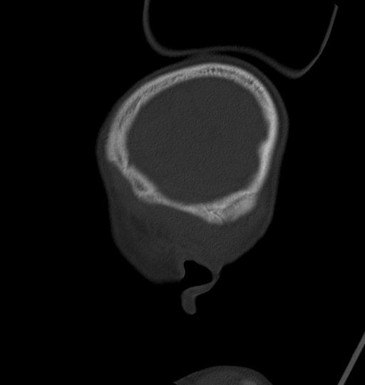 Acute mastoiditis (Radiopaedia 82678-96881 Sagittal bone window 62).jpg
