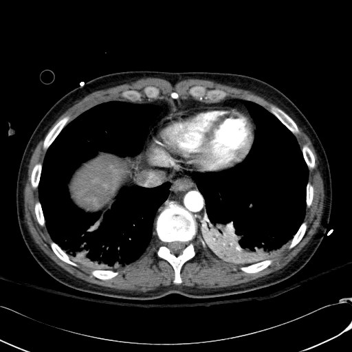 Acute myocardial infarction in CT (Radiopaedia 39947-42415 Axial C+ arterial phase 110).jpg