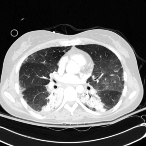 File:Acute myocardial infarction in CT (Radiopaedia 39947-42415 Axial lung window 68).jpg
