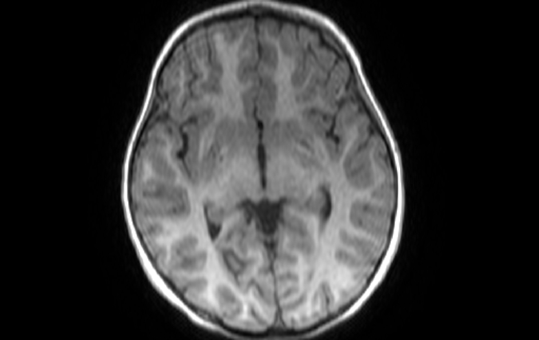 Acute necrotizing encephalitis of childhood (Radiopaedia 67356-76737 Axial T1 52).jpg