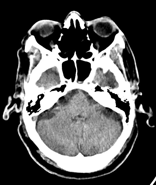 Acute on chronic subdural hematoma (Radiopaedia 78346-90966 Axial non-contrast 20).jpg