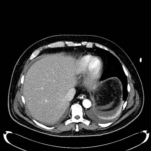 File:Acute pancreatic necrosis (Radiopaedia 13560-18500 Axial C+ portal venous phase 24).jpg