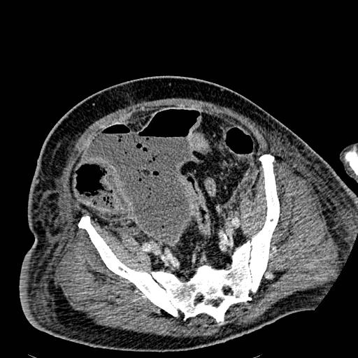 Acute pancreatic necrosis (Radiopaedia 13560-18501 Axial C+ portal venous phase 117).jpg