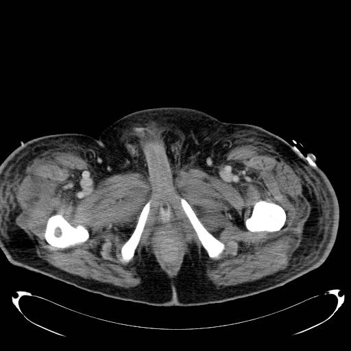 Acute pancreatic necrosis (Radiopaedia 13560-18503 Axial C+ portal venous phase 91).jpg