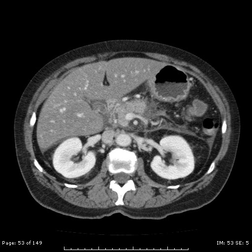 File:Acute pancreatitis (Radiopaedia 23635-23763 C 1).jpg