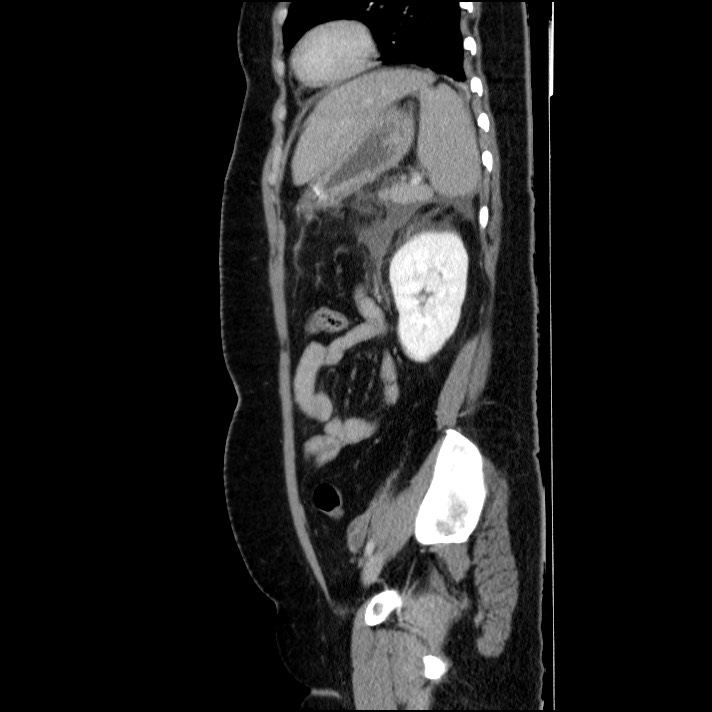 Acute pancreatitis (Radiopaedia 69236-79012 Sagittal C+ portal venous phase 35).jpg