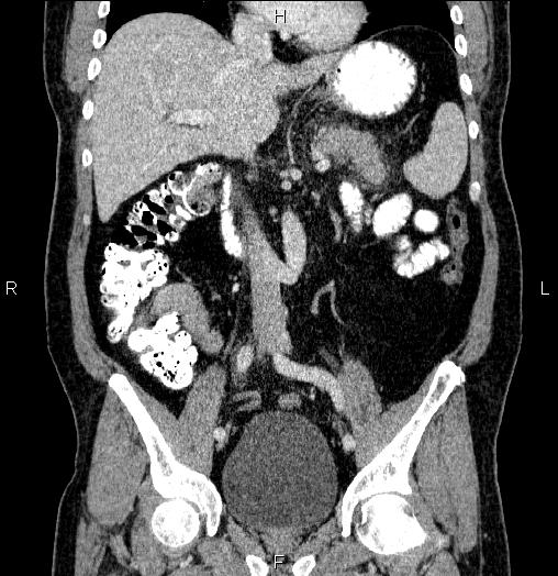 File:Acute pancreatitis (Radiopaedia 85390-101010 Coronal C+ portal venous phase 36).jpg