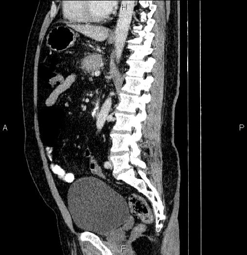 Acute pancreatitis (Radiopaedia 85390-101010 Sagittal C+ portal venous phase 57).jpg