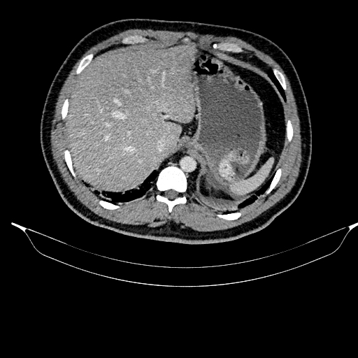 Acute pancreatitis (Radiopaedia 87428-103757 Axial C+ portal venous phase 24).jpg