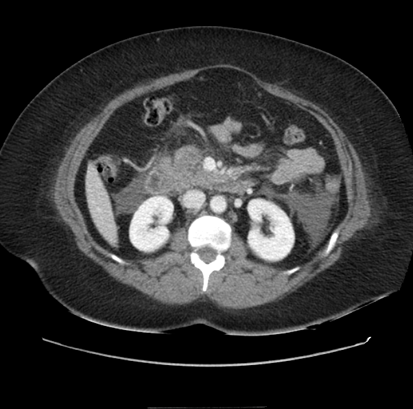 Acute pancreatitis - Balthazar E (Radiopaedia 29016-29377 Axial C+ portal venous phase 30).png