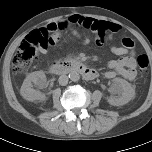 File:Acute pancreatitis and walled-off necrosis (Radiopaedia 29888-30403 Axial non-contrast 35).jpg