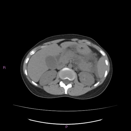 Acute pancreatitis secondary to stone at minor papilla and pancreatic divisum (Radiopaedia 76570-88333 Axial non-contrast 27).jpg