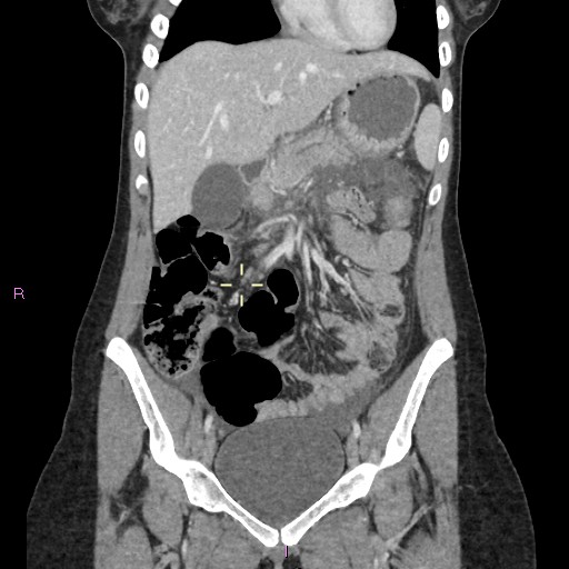 File:Acute pancreatitis secondary to stone at minor papilla and pancreatic divisum (Radiopaedia 76570-88333 Coronal C+ portal venous phase 10).jpg