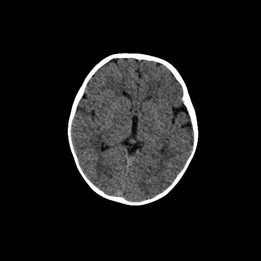 Acute phase of hemiconvulsion-hemiplegia epilepsy syndrome (Radiopaedia 29309-29744 Axial non-contrast 28).jpg