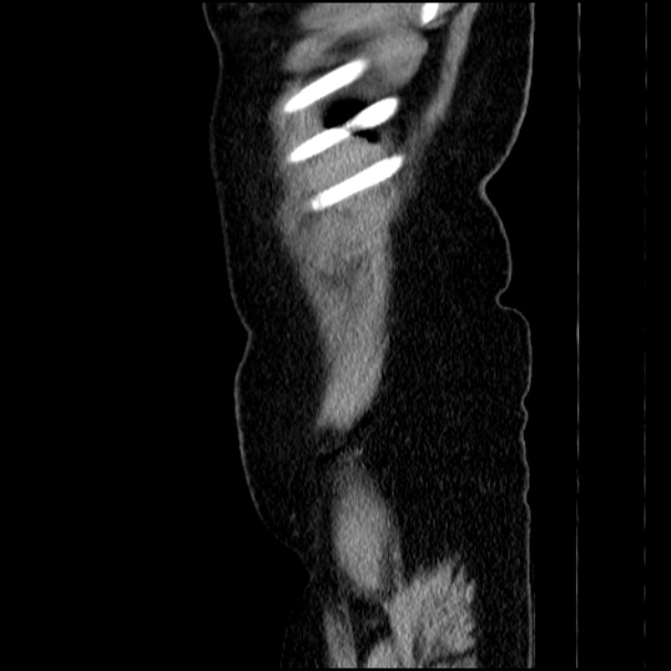 Acute pyelonephritis (Radiopaedia 33397-34434 Sagittal renal parenchymal phase 9).jpg