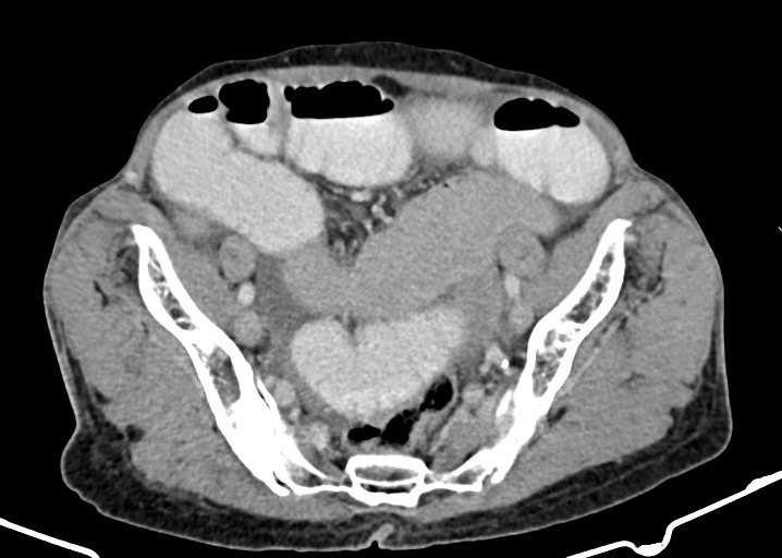 Acute small bowel (ileal) volvulus (Radiopaedia 71740-82139 Axial C+ portal venous phase 159).jpg