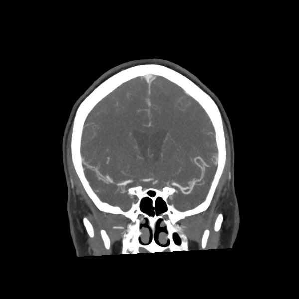 Acute subarachnoid hemorrhage and accessory anterior cerebral artery (Radiopaedia 69231-79009 Coronal C+ arterial phase 34).jpg