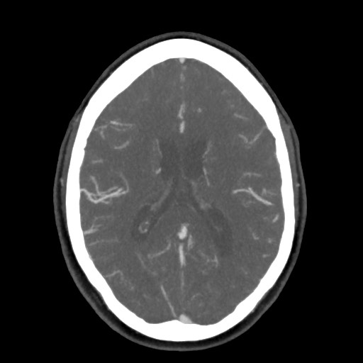 Acute subarachnoid hemorrhage and accessory anterior cerebral artery (Radiopaedia 69231-79009 D 42).jpg