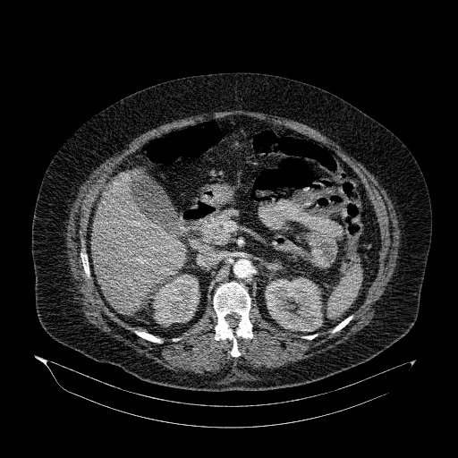 File:Acute superior mesenteric artery occlusion (Radiopaedia 51288-56960 Axial C+ arterial phase 30).jpg