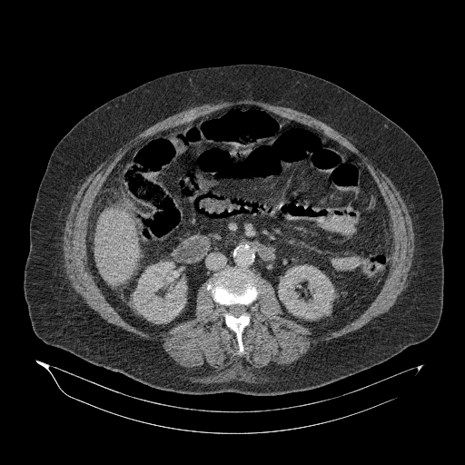 File:Acute superior mesenteric artery occlusion (Radiopaedia 51288-56960 Axial C+ portal venous phase 48).jpg