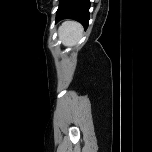 Acute uncomplicated appendicitis (Radiopaedia 73704-84499 Sagittal C+ portal venous phase 174).jpg