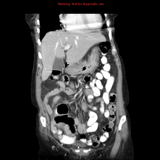 File:Adenocarcinoma of the colon (Radiopaedia 8191-9039 Coronal liver window 14).jpg