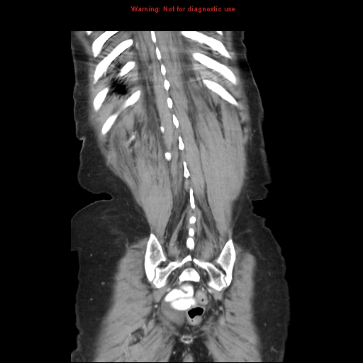 File:Adenocarcinoma of the colon (Radiopaedia 8191-9039 Coronal liver window 41).jpg