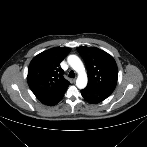 File:Adenocarcinoma of the lung (Radiopaedia 59871-67325 Axial C+ arterial phase 29).jpg