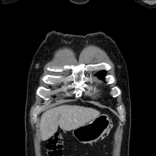 Adenocarcinoma of the lung (Radiopaedia 59871-67325 Coronal C+ arterial phase 5).jpg