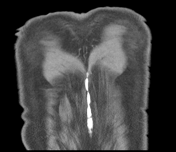 Adenocarcioma of rectum- T1 lesion (Radiopaedia 36921-38547 Coronal C+ arterial phase 59).png