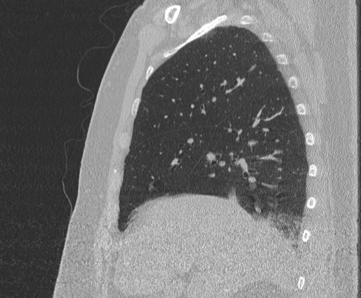 File:Adenoid cystic carcinoma of the trachea (Radiopaedia 49042-54137 Sagittal lung window 143).jpg